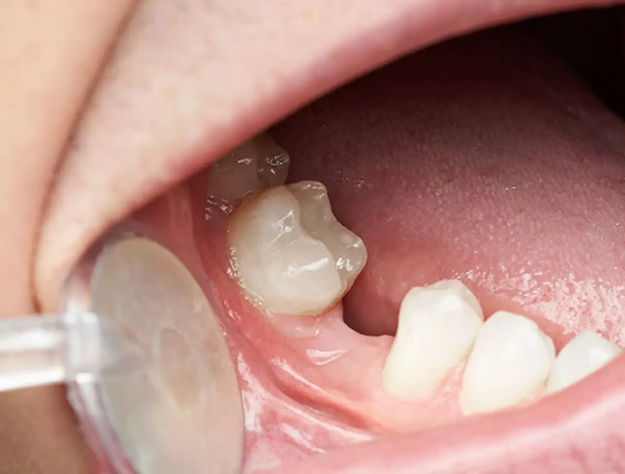 Rüyada Diş Dökülmesi Korkutuyor! Uzmanlar Uyardı: Bu Rüya Önemli Mesajlar Taşıyor 2