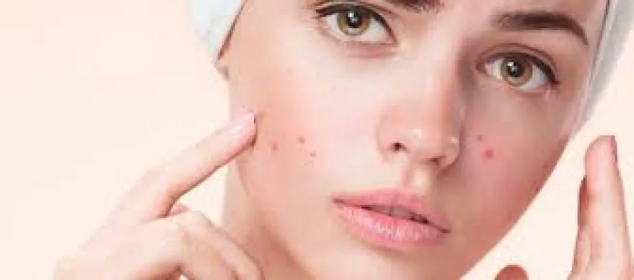 Yüzde Çıkan Sivilceler Artıyor! Uzmanlar Uyarıyor: Günlük Cilt Bakımındaki Küçük Hatalar Büyük Sorunlara Yol Açıyor 2