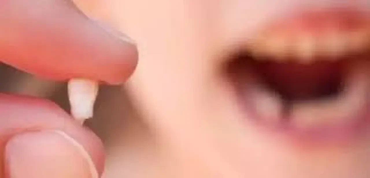 Rüyada Diş Dökülmesi Korkutuyor! Uzmanlar Uyardı: Bu Rüya Önemli Mesajlar Taşıyor 1