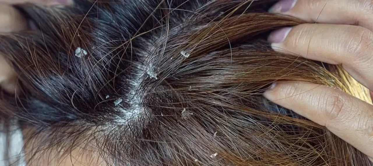 Saçtaki Kepek Neden Olur? Uzmanlardan Etkili Çözüm Önerileri! 2