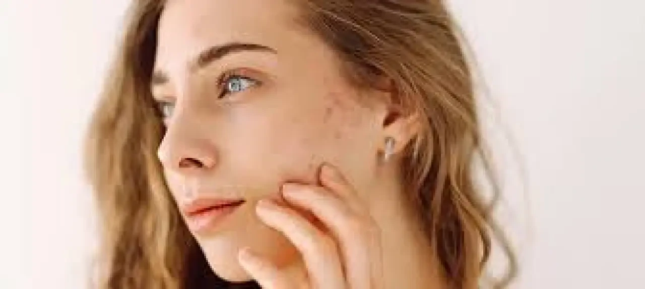 Yüzde Çıkan Sivilceler Artıyor! Uzmanlar Uyarıyor: Günlük Cilt Bakımındaki Küçük Hatalar Büyük Sorunlara Yol Açıyor 1