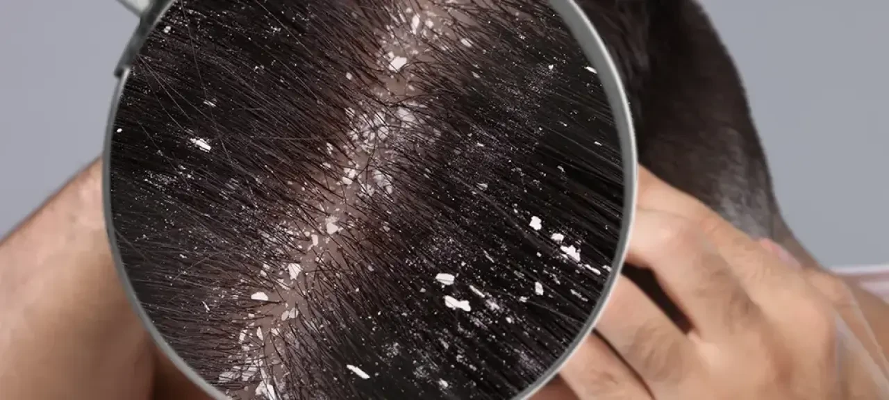 Saçtaki Kepek Neden Olur? Uzmanlardan Etkili Çözüm Önerileri! 3