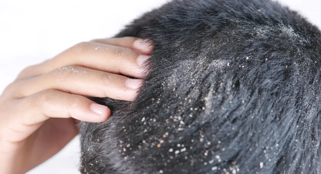 Saçtaki Kepek Neden Olur? Uzmanlardan Etkili Çözüm Önerileri! 1