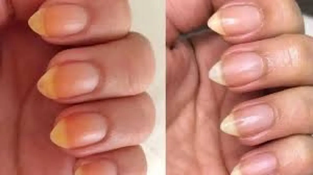 Sararmış Tırnaklar Neden Olur? Uzmanlar Uyarıyor: Basit Bir Sorun Olmayabilir 1