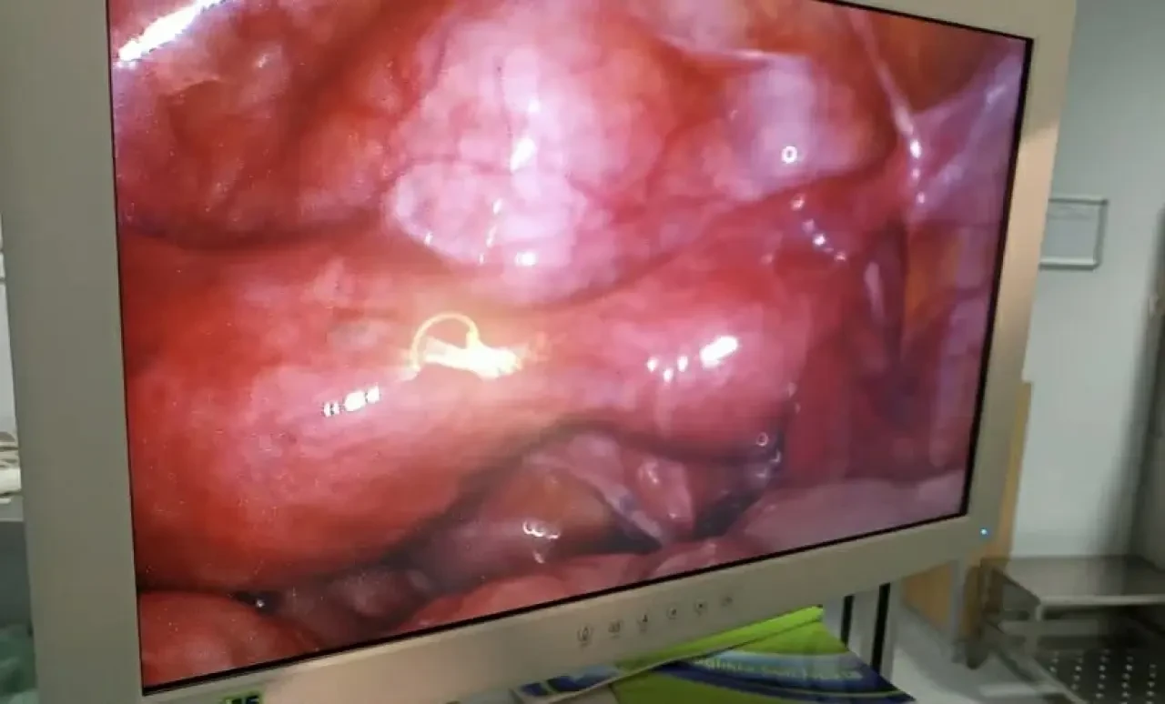 Merzifon’da Tıp Mucizesi: Çift Rahim Tek Oldu 1