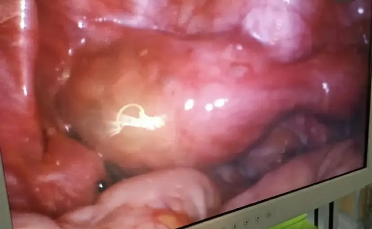 Merzifon’da Tıp Mucizesi: Çift Rahim Tek Oldu 2