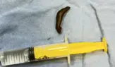 Çorum’da Şoke Eden Olay: Boğazından Sülük Çıktı!