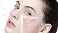 Yüzde Çıkan Sivilceler Artıyor! Uzmanlar Uyarıyor: Günlük Cilt Bakımındaki Küçük Hatalar Büyük Sorunlara Yol Açıyor