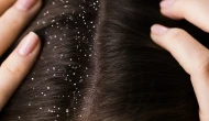 Saçtaki Kepek Neden Olur? Uzmanlardan Etkili Çözüm Önerileri!