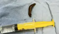 Çorum’da Şoke Eden Olay: Boğazından Sülük Çıktı!