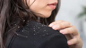Saçında Kepek Olanlar Dikkat! Bu Belirtiler Ciddi Bir Sorunun Habercisi Olabilir!