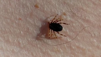 Çorum’da kenenin ısırdığı adam kurtarılamadı