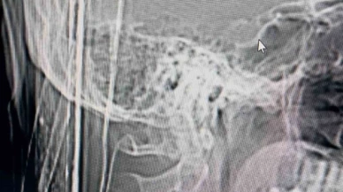 Arkadaşını beklerken kafasına yorgun mermi isabet etti