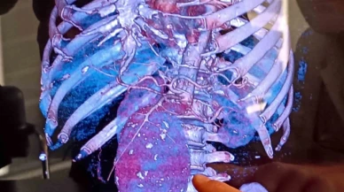 Aort damarı kalp büyüklüğünde şişen hastayı aynı anda 2 ameliyatla hayatta tuttular