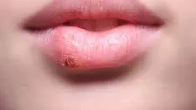 Ağızda Çıkan Uçuk Neden Olur? Uzmanlardan Önemli Uyarılar!