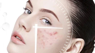 Yüzde Çıkan Sivilceler Artıyor! Uzmanlar Uyarıyor: Günlük Cilt Bakımındaki Küçük Hatalar Büyük Sorunlara Yol Açıyor