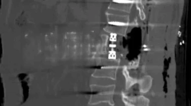 Omur gövdesi çıkarılarak yapılan ameliyat başarıyla gerçekleşti