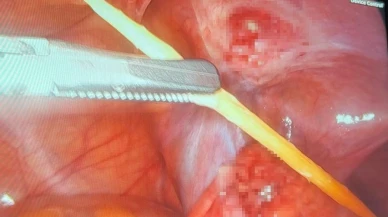 17 yaşındaki bir hastanın kalın bağırsağını delen kürdan kapalı yöntemle çıkarıldı