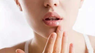 Uçukları Anında Yok Ediyor! Bir Parça Buz Yeterli Oluyor