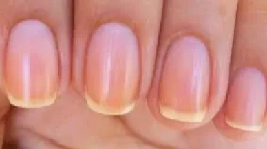 Sararmış Tırnaklar Neden Olur? Uzmanlar Uyarıyor: Basit Bir Sorun Olmayabilir