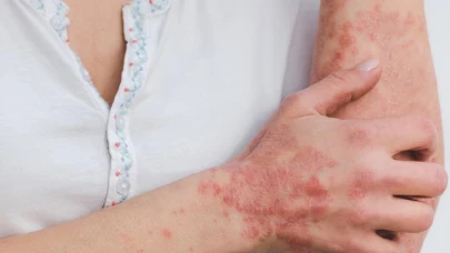Gül hastalığı kadınlar ve açık tenlilerde daha çok görülüyor