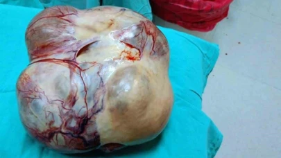 Ameliyattan korkup kaçtı, vücudundan 15 kiloluk dev kitle çıktı