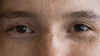 Lekesiz Cildin Sırrı: Limon Kürü!