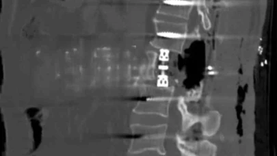 Omur gövdesi çıkarılarak yapılan ameliyat başarıyla gerçekleşti