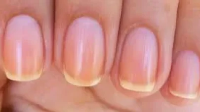 Sararmış Tırnaklar Neden Olur? Uzmanlar Uyarıyor: Basit Bir Sorun Olmayabilir