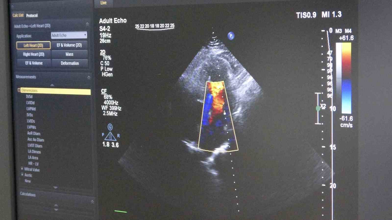 ameliyatsiz-stentsiz-tedavi-kalp-damarlari-ilac-kapli-balonla-acildi