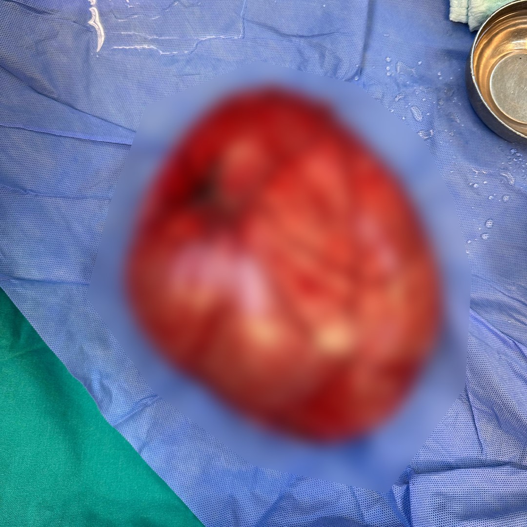 kilo-vermek-icin-hastaneye-giden-cocugun-karnindan-35-kiloluk-kist-cikti